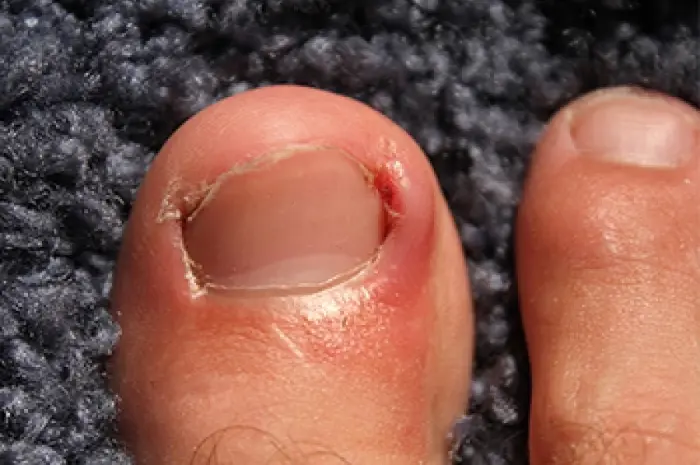 Ingrown Toe Nail Fungus